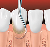 Periodontal Root Planing