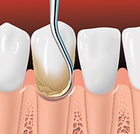 Periodontal Scaling